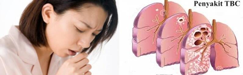 Batuk Anda Tidak Kunjung Sembuh ??, HATI-HATI TANDA INFEKSI TBC !!