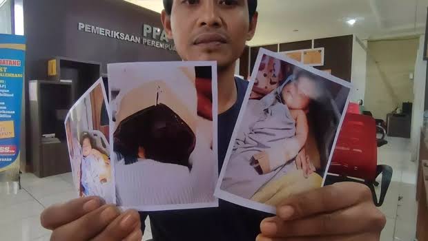 Diberi Tahu Malah Ngeyel, Perawat RS Potong Jari Tangan Bayi hingga Putus, Keluarga Mau Damai Asalkan Rp500 Juta