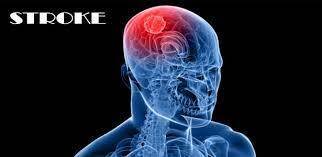 Jangka Waktu Dua Bulan, Belasan Penyakit Stroke Terdata